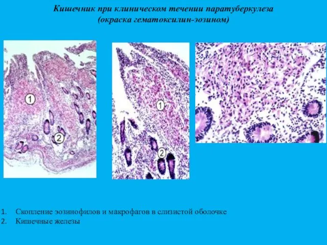 Кишечник при клиническом течении паратуберкулеза (окраска гематоксилин-эозином) Скопление эозинофилов и макрофагов в слизистой оболочке Кишечные железы