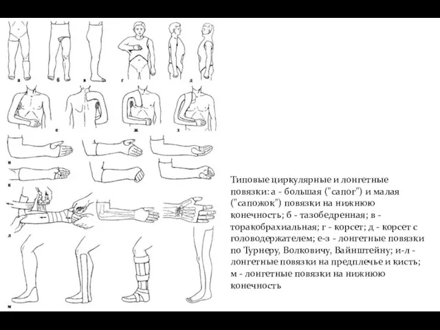 Типовые циркулярные и лонгетные повязки: а - большая ("сапог") и