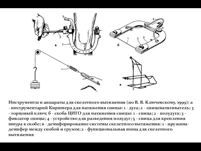 Инструменты и аппараты для скелетного вытяжения (по В. В. Ключевскому,