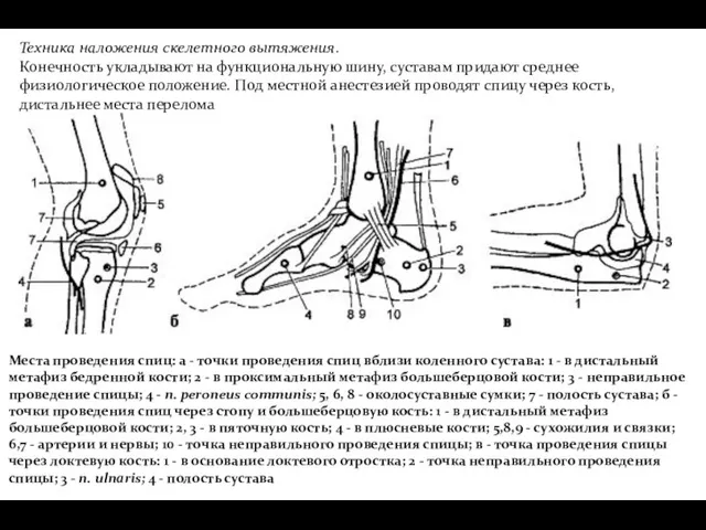 Техника наложения скелетного вытяжения. Конечность укладывают на функциональную шину, суставам