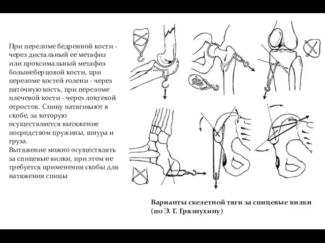 При переломе бедренной кости - через дистальный ее метафиз или