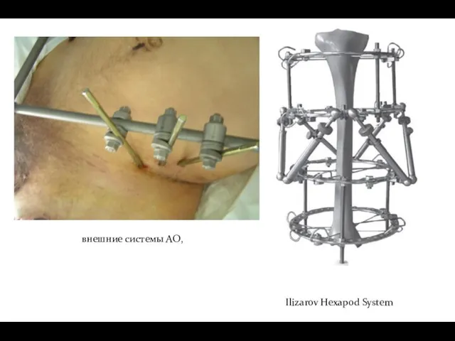 внешние системы АО, Ilizarov Hexapod System