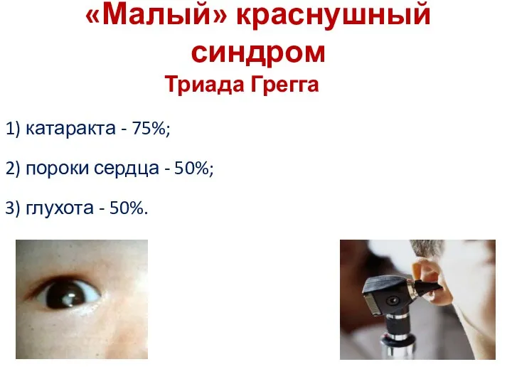 «Малый» краснушный синдром Триада Грегга 1) катаракта - 75%; 2)