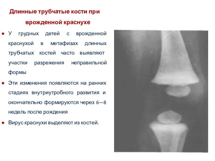 Длинные трубчатые кости при врожденной краснухе У грудных детей с