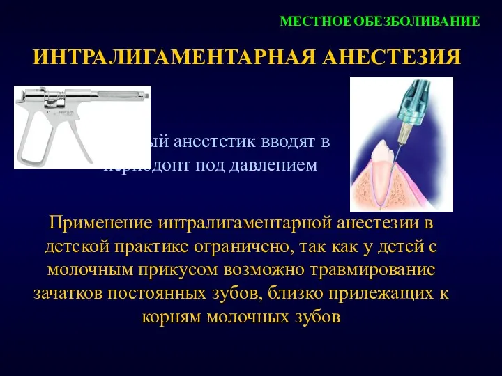 ИНТРАЛИГАМЕНТАРНАЯ АНЕСТЕЗИЯ местный анестетик вводят в периодонт под давлением МЕСТНОЕ