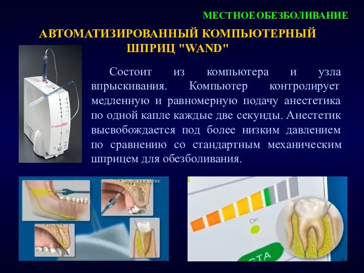 АВТОМАТИЗИРОВАННЫЙ КОМПЬЮТЕРНЫЙ ШПРИЦ "WAND" МЕСТНОЕ ОБЕЗБОЛИВАНИЕ Состоит из компьютера и