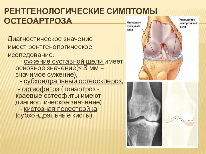 РЕНТГЕНОЛОГИЧЕСКИЕ СИМПТОМЫ ОСТЕОАРТРОЗА Диагностическое значение имеет рентгенологическое исследование: - сужение суставной щели имеет