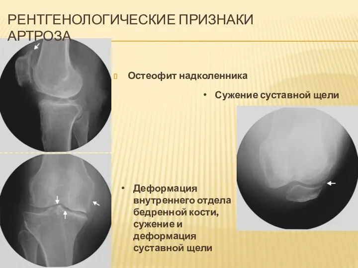 РЕНТГЕНОЛОГИЧЕСКИЕ ПРИЗНАКИ АРТРОЗА Остеофит надколенника Сужение суставной щели Деформация внутреннего