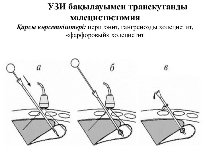 УЗИ бақылауымен транскутанды холецистостомия Қарсы көрсеткіштері: перитонит, гангренозды холецистит, «фарфоровый» холецистит