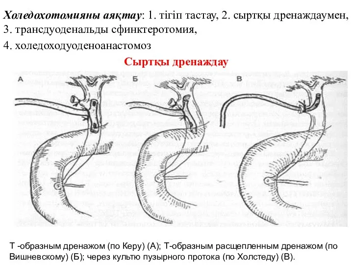 Холедохотомияны аяқтау: 1. тігіп тастау, 2. сыртқы дренаждаумен, 3. трансдуоденальды