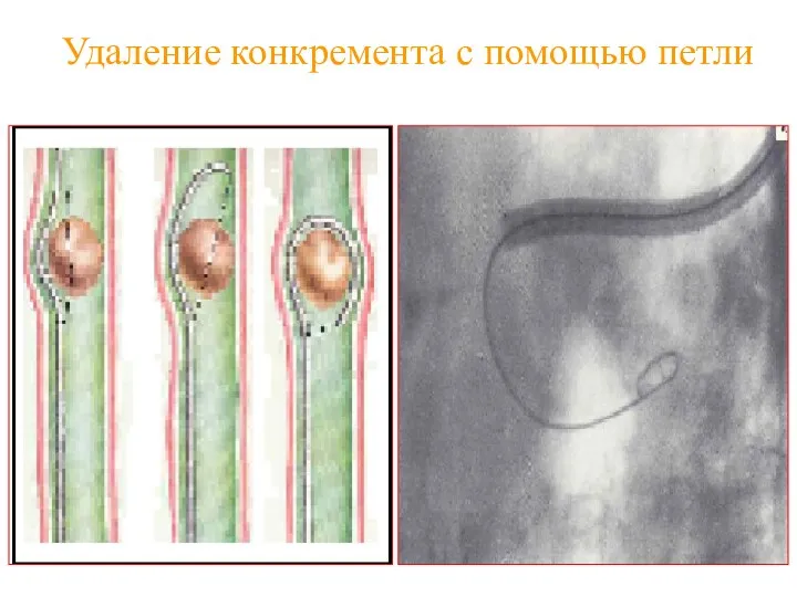 Удаление конкремента с помощью петли