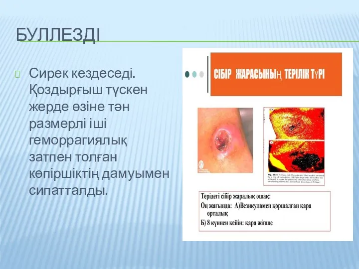 БУЛЛЕЗДІ Сирек кездеседі. Қоздырғыш түскен жерде өзіне тән размерлі іші геморрагиялық затпен толған көпіршіктің дамуымен сипатталды.