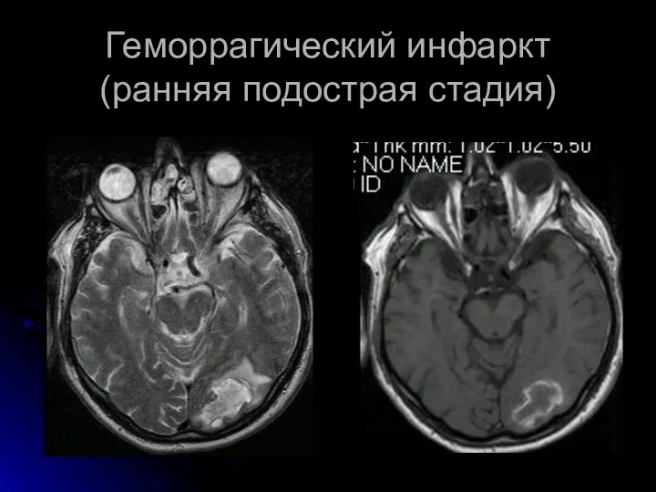 Геморрагический инфаркт (ранняя подострая стадия)