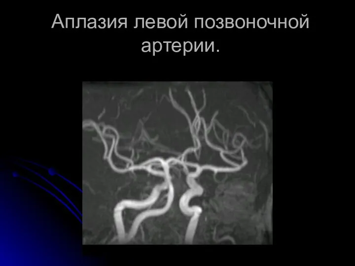Аплазия левой позвоночной артерии.