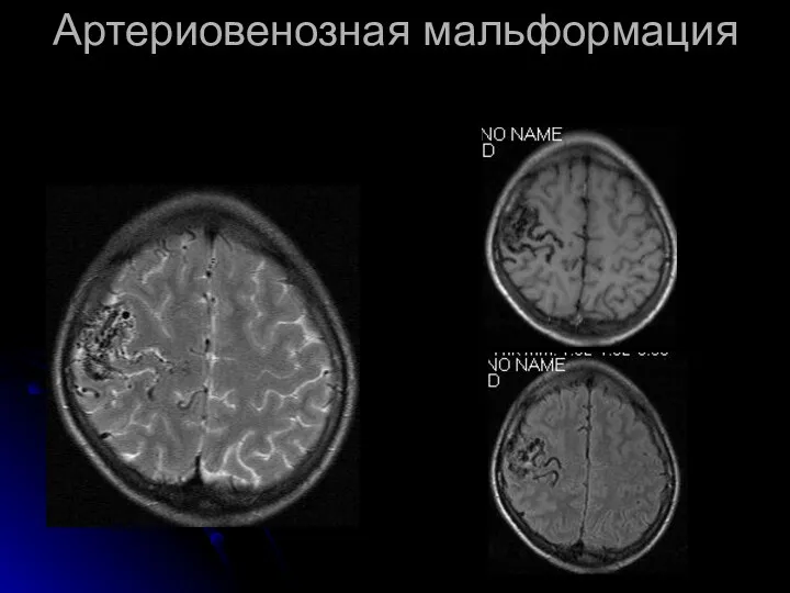 Артериовенозная мальформация