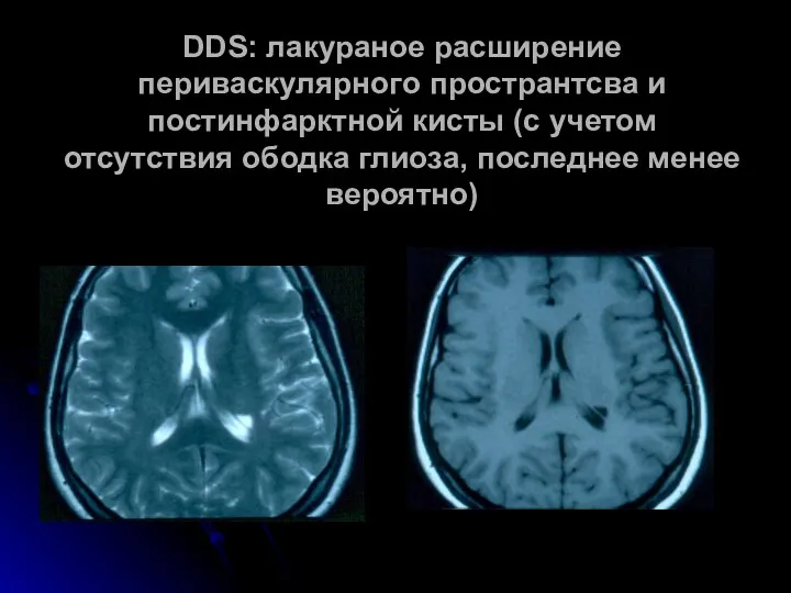 DDS: лакураное расширение периваскулярного пространтсва и постинфарктной кисты (с учетом отсутствия ободка глиоза, последнее менее вероятно)