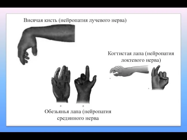 Висячая кисть (нейропатия лучевого нерва) Обезьянья лапа (нейропатия срединного нерва Когтистая лапа (нейропатия локтевого нерва)