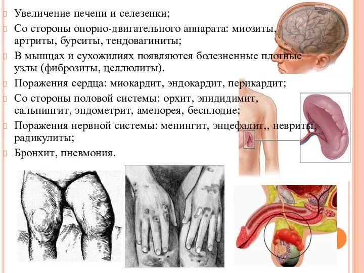 Увеличение печени и селезенки; Со стороны опорно-двигательного аппарата: миозиты, артриты,