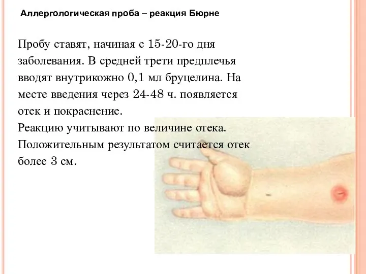 Аллергологическая проба – реакция Бюрне Пробу ставят, начиная с 15-20-го