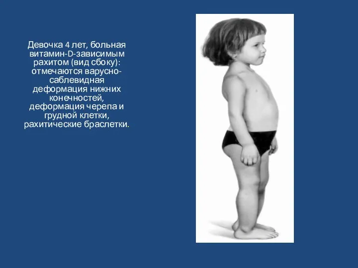 Девочка 4 лет, больная витамин-D-зависимым рахитом (вид сбоку): отмечаются варусно-саблевидная