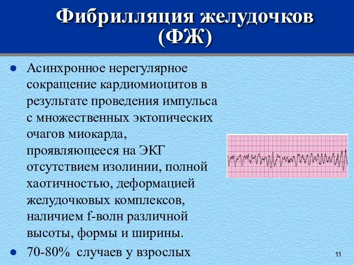 Фибрилляция желудочков (ФЖ) Асинхронное нерегулярное сокращение кардиомиоцитов в результате проведения импульса с множественных