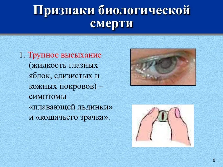 Признаки биологической смерти 1. Трупное высыхание (жидкость глазных яблок, слизистых и кожных покровов)