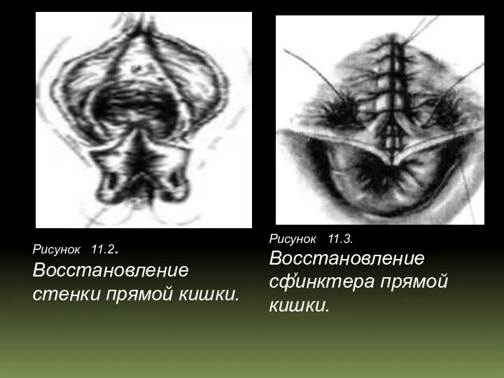 у Рисунок 11.2. Восстановление стенки прямой кишки. Рисунок 11.3. Восстановление сфинктера прямой кишки.