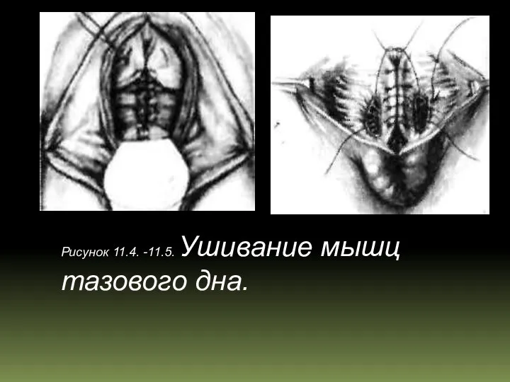 Рисунок 11.4. -11.5. Ушивание мышц тазового дна.