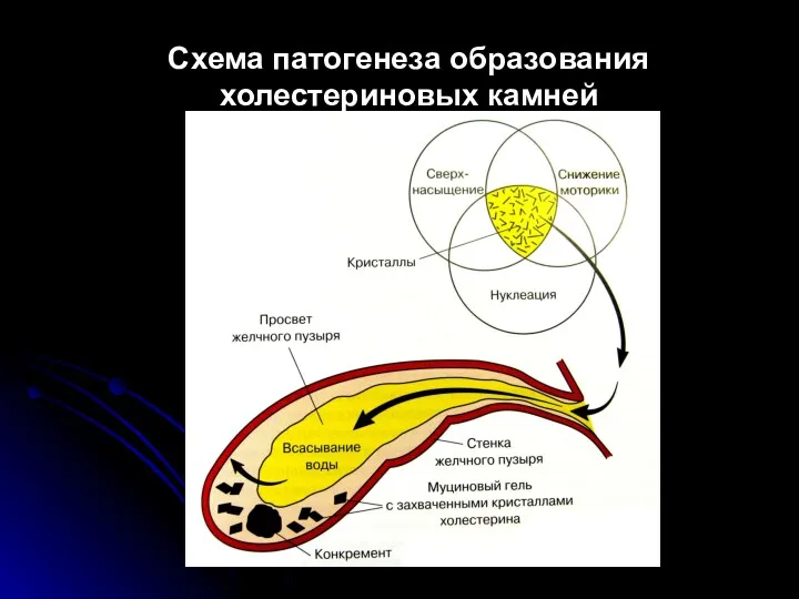 Схема патогенеза образования холестериновых камней