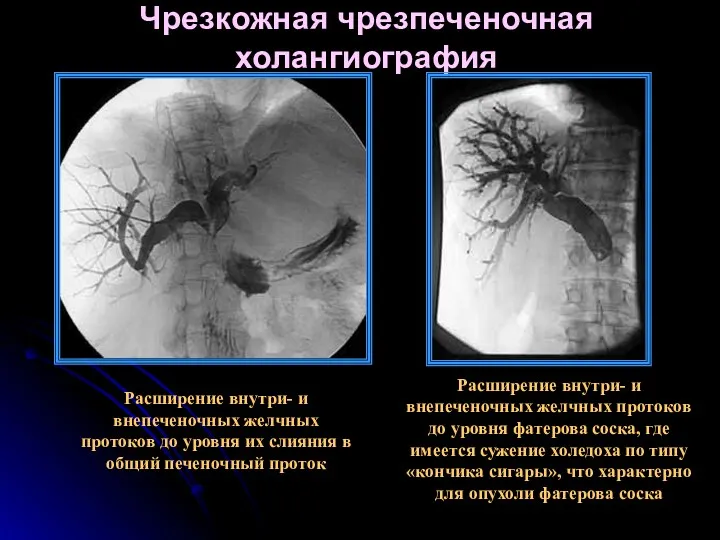 Чрезкожная чрезпеченочная холангиография Расширение внутри- и внепеченочных желчных протоков до уровня фатерова соска,