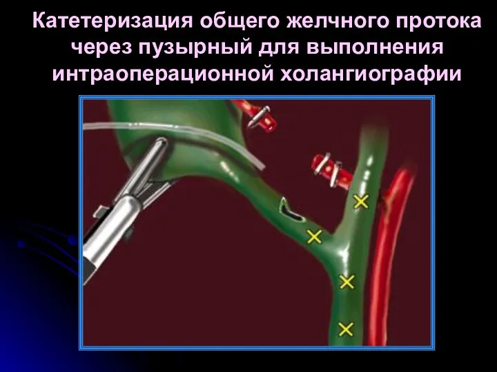 Катетеризация общего желчного протока через пузырный для выполнения интраоперационной холангиографии