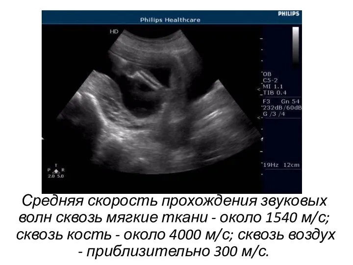 Средняя скорость прохождения звуковых волн сквозь мягкие ткани - около