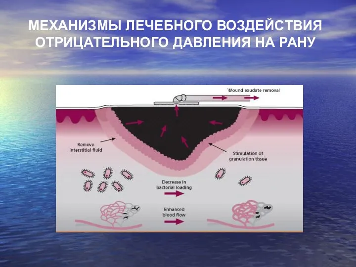 МЕХАНИЗМЫ ЛЕЧЕБНОГО ВОЗДЕЙСТВИЯ ОТРИЦАТЕЛЬНОГО ДАВЛЕНИЯ НА РАНУ