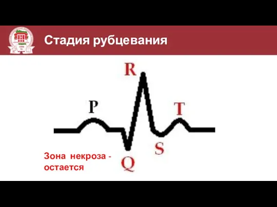 Стадия рубцевания Зона некроза - остается