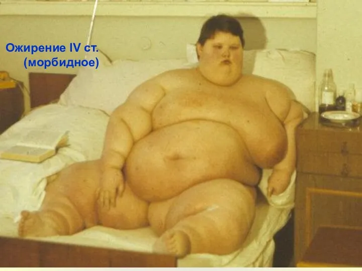 Ожирение IV ст. (морбидное)