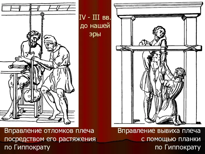 Вправление отломков плеча посредством его растяжения по Гиппократу Вправление вывиха