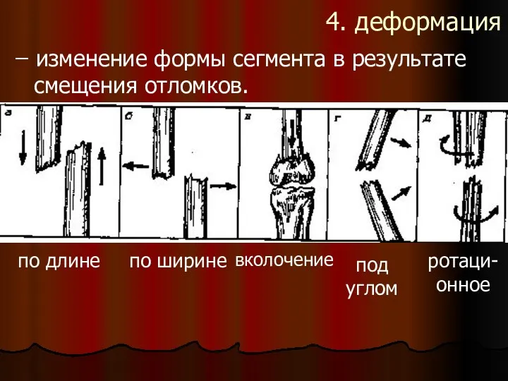 4. деформация ̶ изменение формы сегмента в результате смещения отломков.