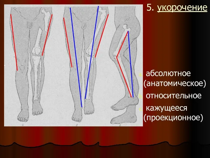 5. укорочение абсолютное (анатомическое) относительное кажущееся (проекционное)