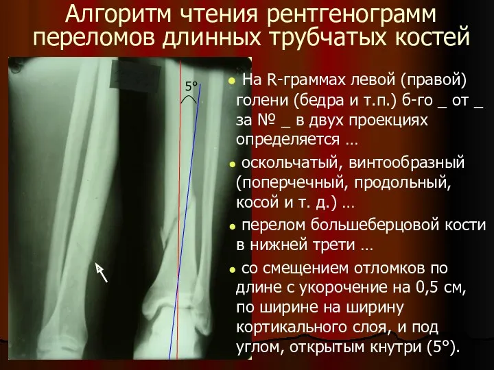 Алгоритм чтения рентгенограмм переломов длинных трубчатых костей На R-граммах левой