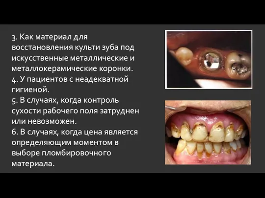 3. Как материал для восстановления культи зуба под искусственные металлические