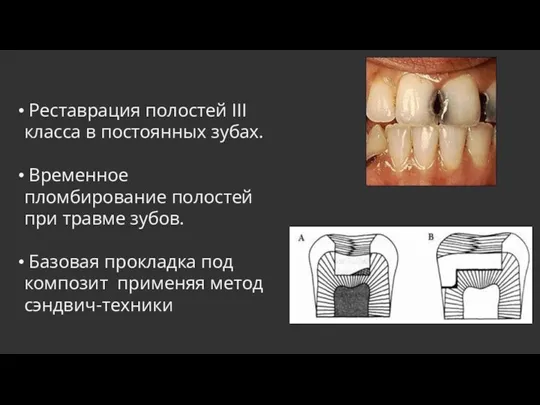 Реставрация полостей III класса в постоянных зубах. Временное пломбирование полостей