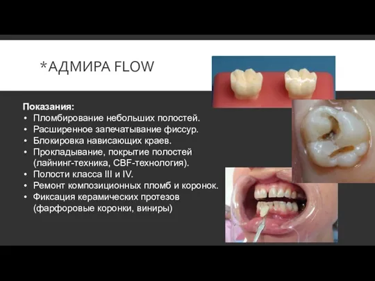 *АДМИРА FLOW Показания: Пломбирование небольших полостей. Расширенное запечатывание фиссур. Блокировка