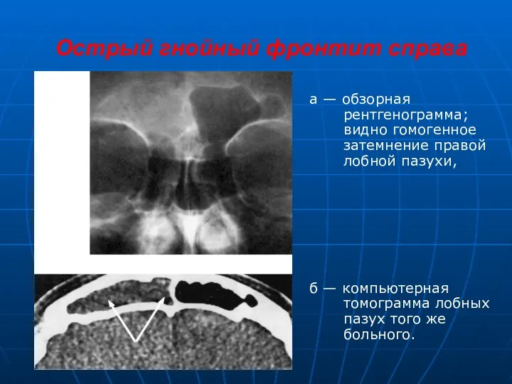 Острый гнойный фронтит справа а — обзорная рентгенограмма; видно гомогенное
