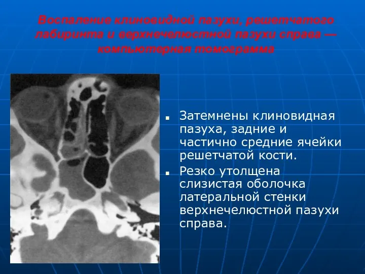 Воспаление клиновидной пазухи, решетчатого лабиринта и верхнечелюстной пазухи справа —