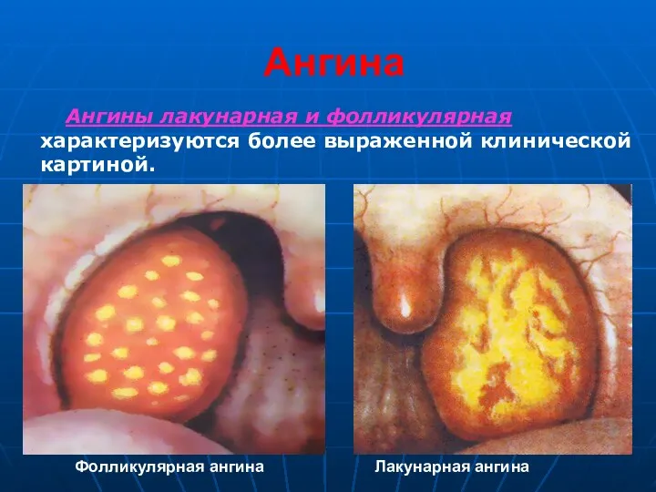 Ангина Ангины лакунарная и фолликулярная характеризуются более выраженной клинической картиной. Фолликулярная ангина Лакунарная ангина