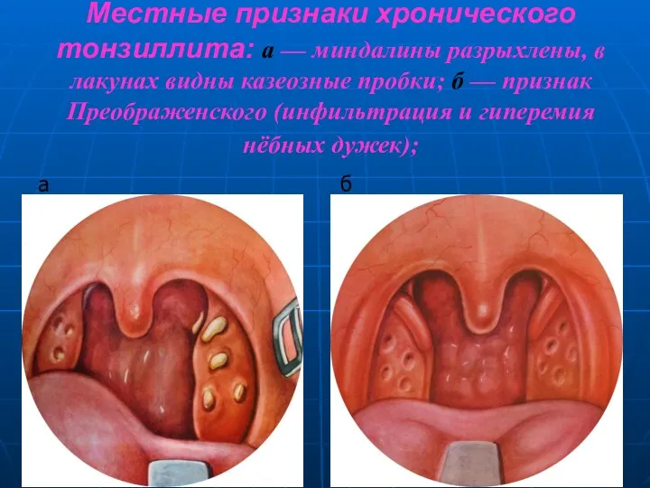 Местные признаки хронического тонзиллита: а — миндалины разрыхлены, в лакунах