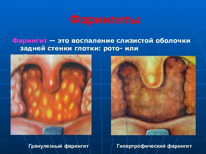 Фарингиты Фарингит — это воспаление слизистой оболочки задней стенки глотки: