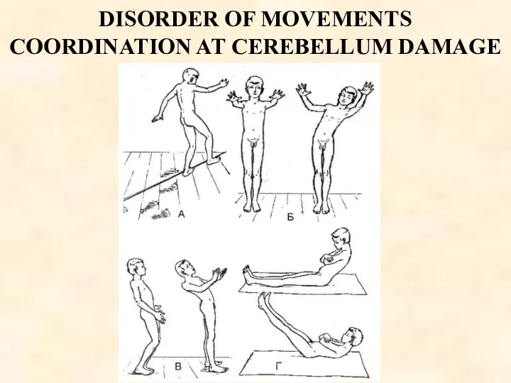 DISORDER OF MOVEMENTS COORDINATION AT CEREBELLUM DAMAGE
