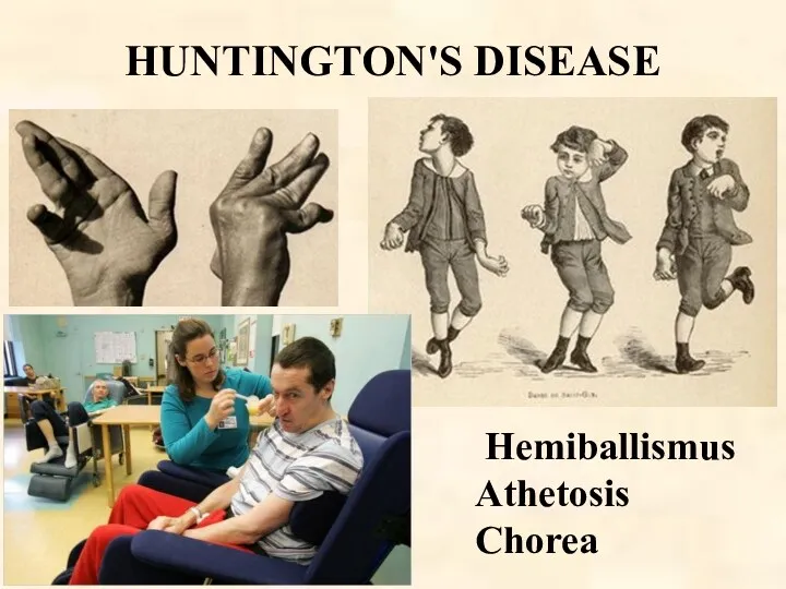 HUNTINGTON'S DISEASE Hemiballismus Athetosis Chorea