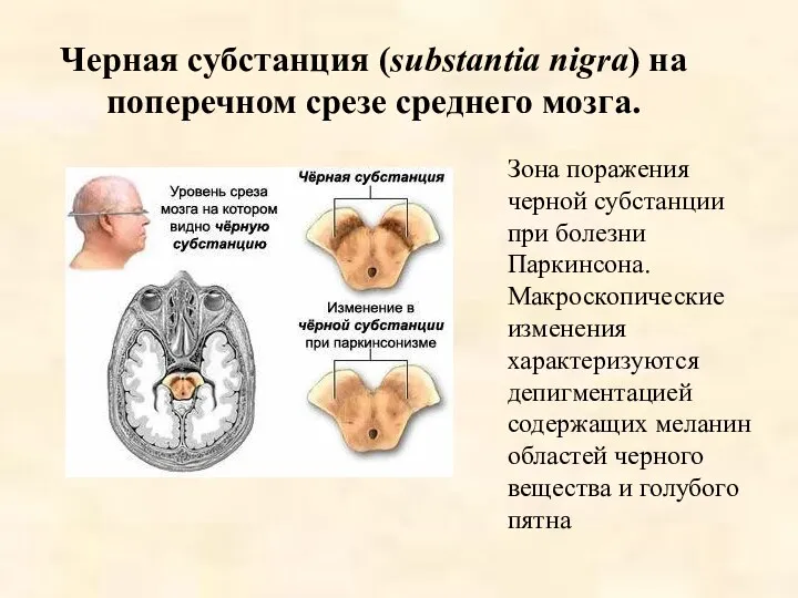 Черная субстанция (substantia nigra) на поперечном срезе среднего мозга. Зона